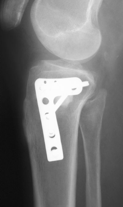 Synthes Proximal Tibial Plate Implant 248